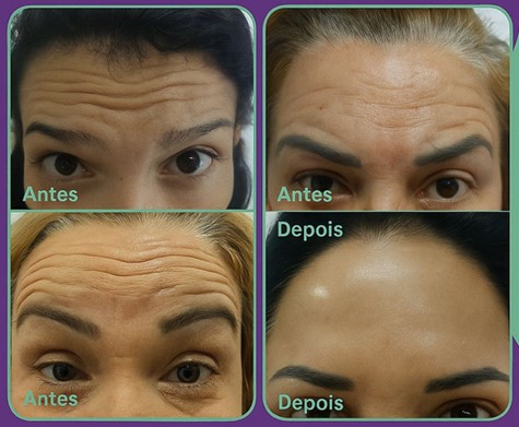 Botox Day Ponto de Equilíbrio